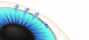 diagram of eye releasing pressure from hydrus microstent