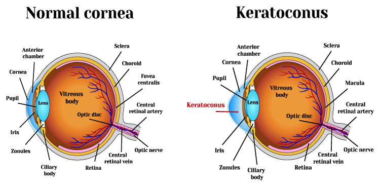 Keratoconus Chart Keratoconus Chart