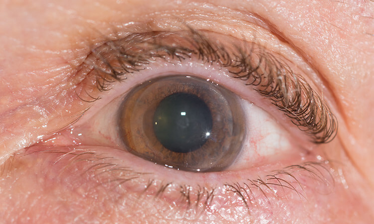 Penetrating Keratoplasty PKP
