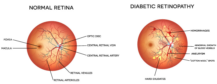 Diabetic Retinopathy Diabetic Retinopathy